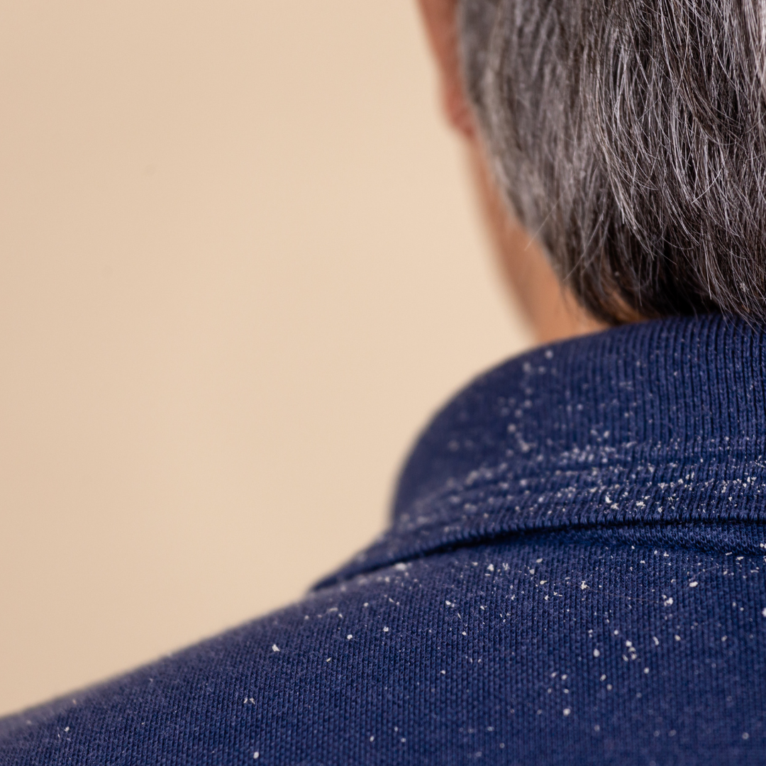 Man with Dandruff