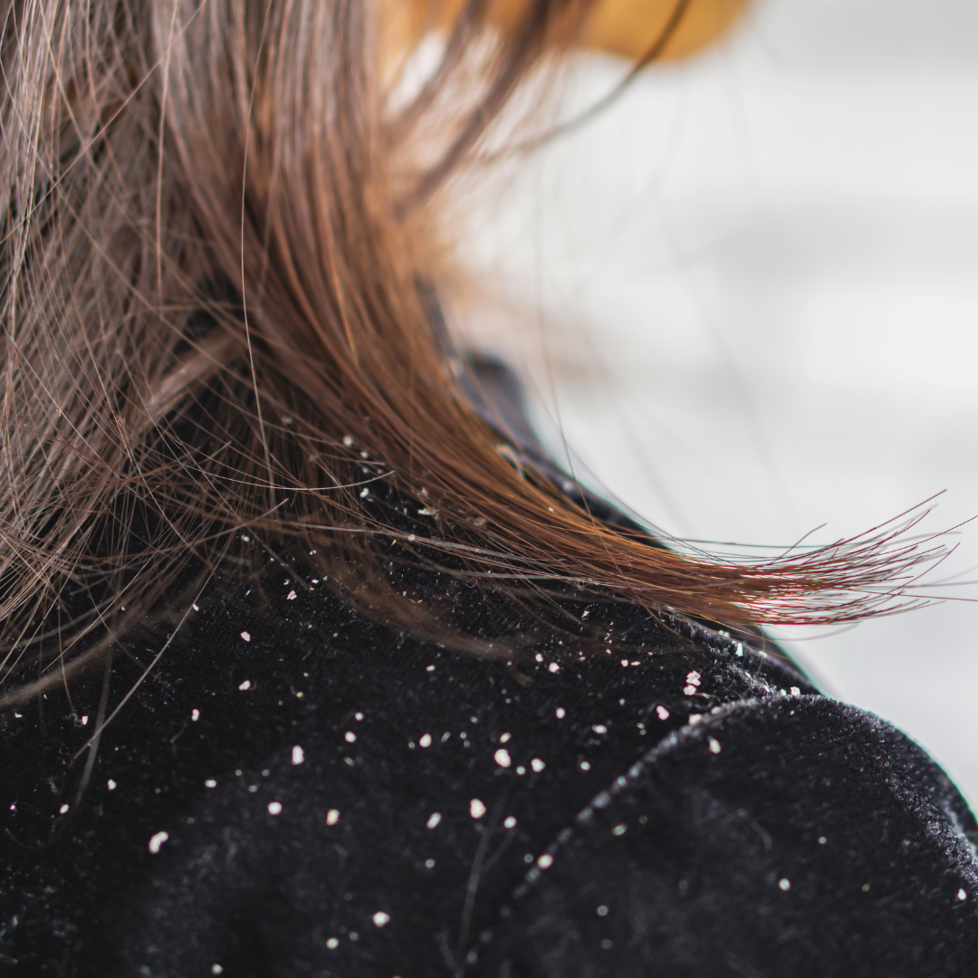 Dandruff falls on shoulder