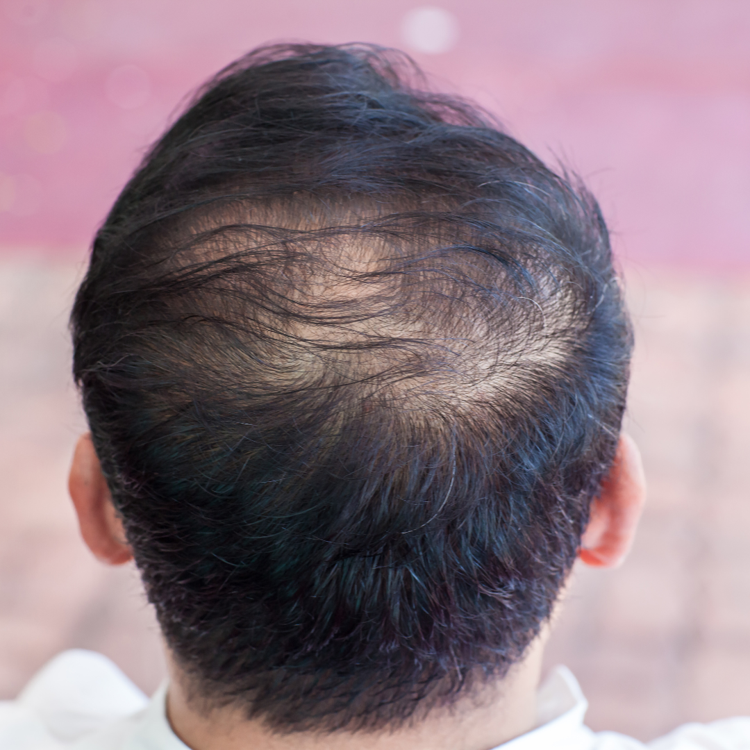Close up hair loss, thinning hair and scalp issue. 