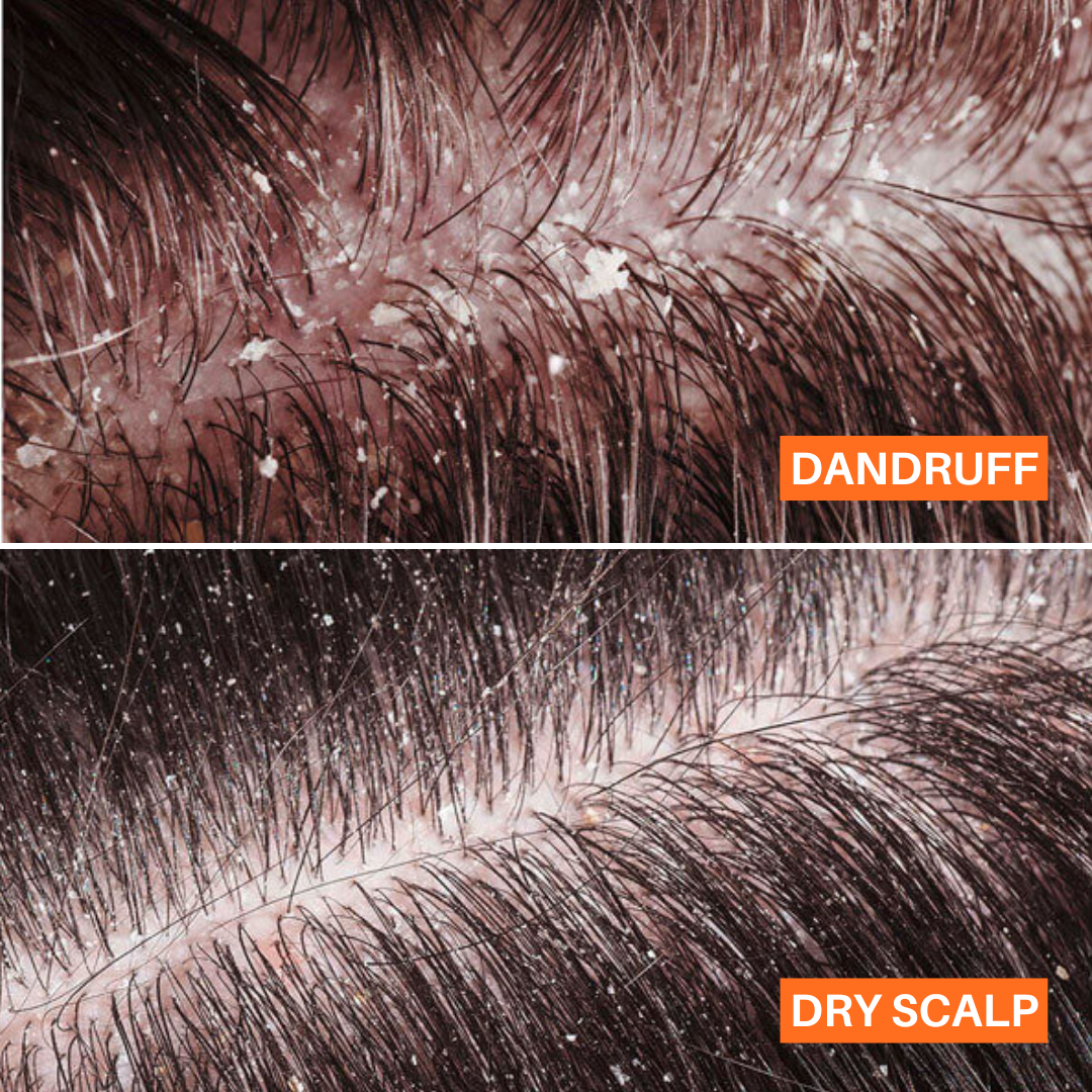 difference between dandruff and dry scalp