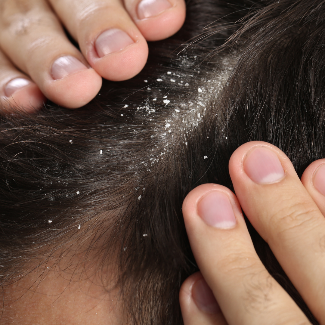 pointing at the flakes on scalp