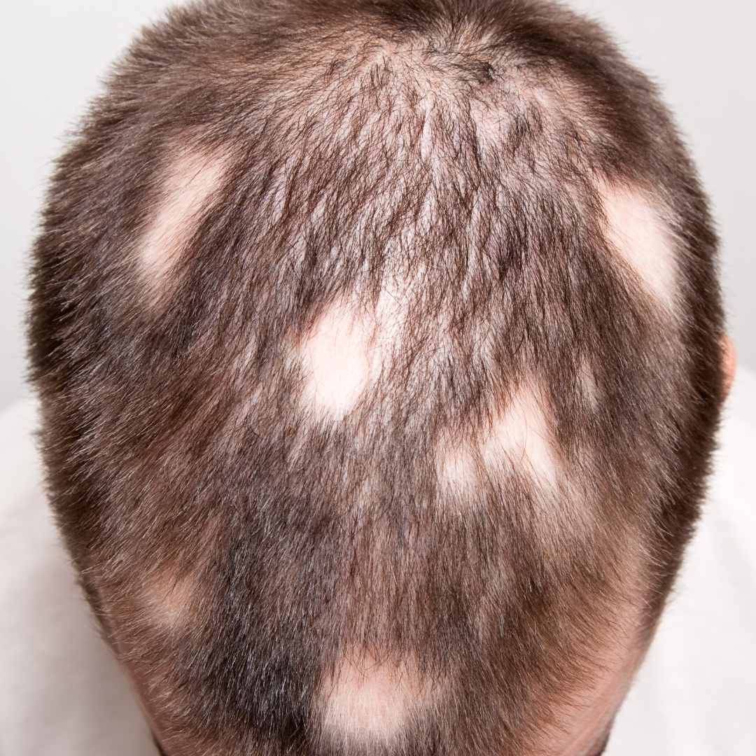 Early Signs of Pattern Hair Loss in Men and Women