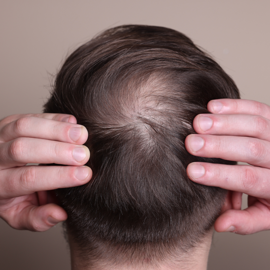Showing his baldness