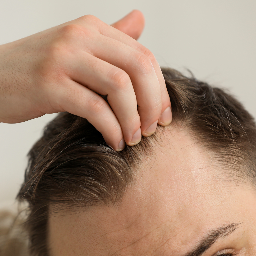 Man with Receding Hairline