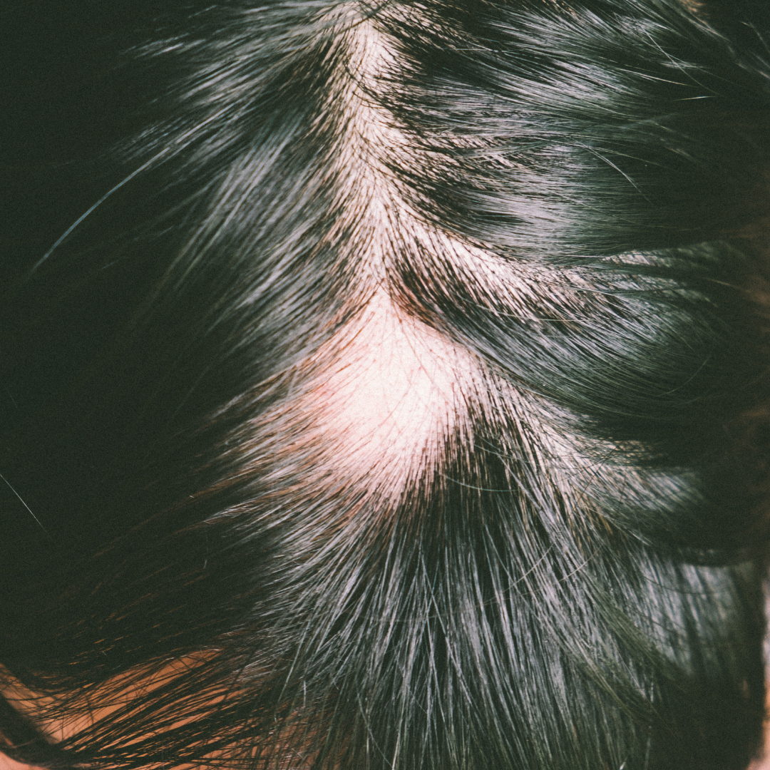 What Is DHT-Related Hair Loss and How Is It Different From Normal Shedding?
