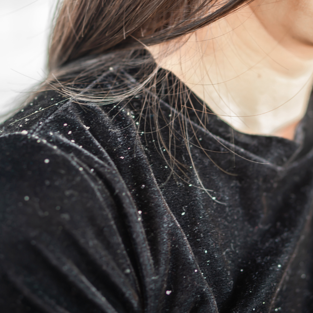 flakes on black shirt