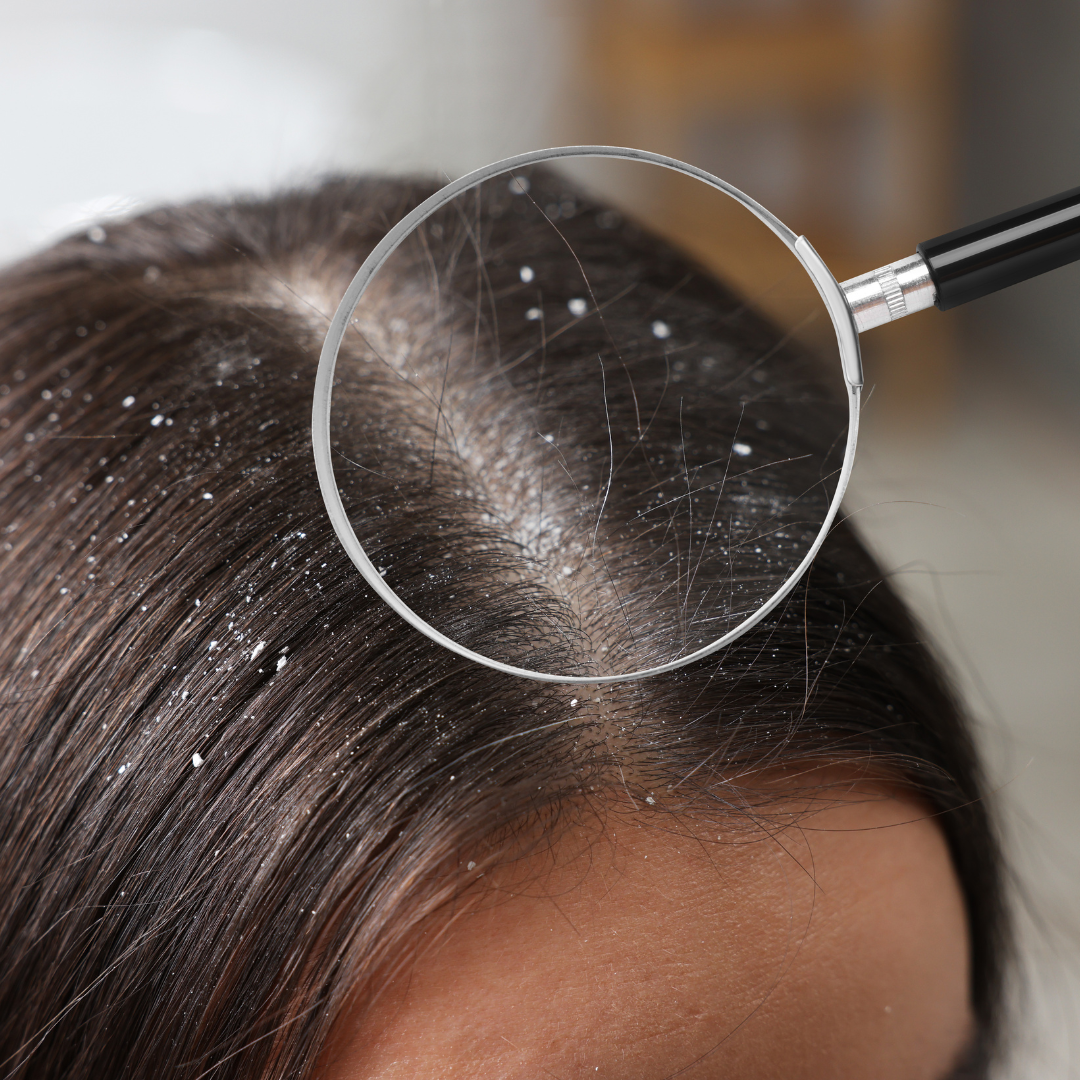 magnifying glass that shows dandruff on women scalp