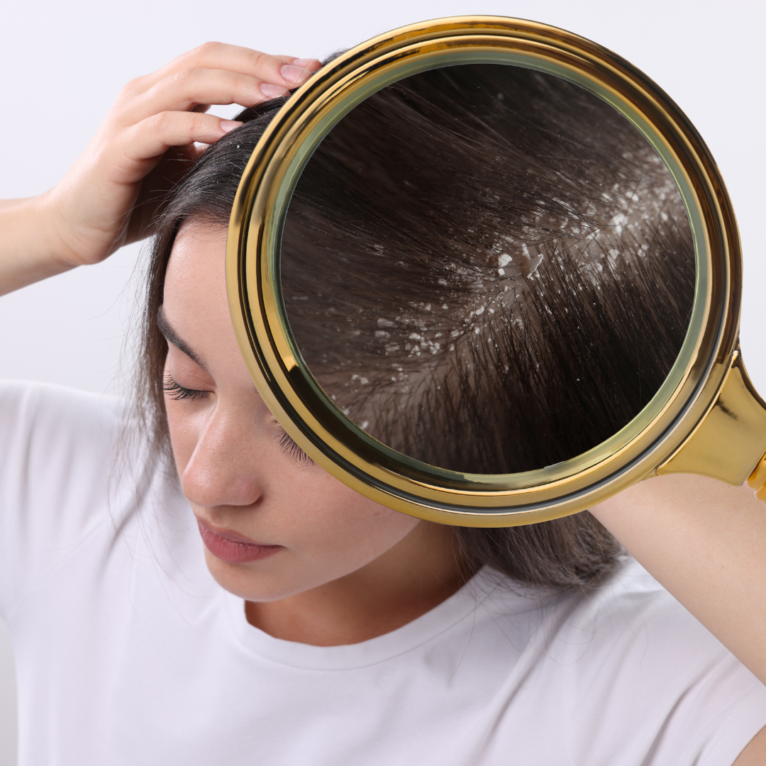 How Does Salicylic Acid Work on Dandruff?