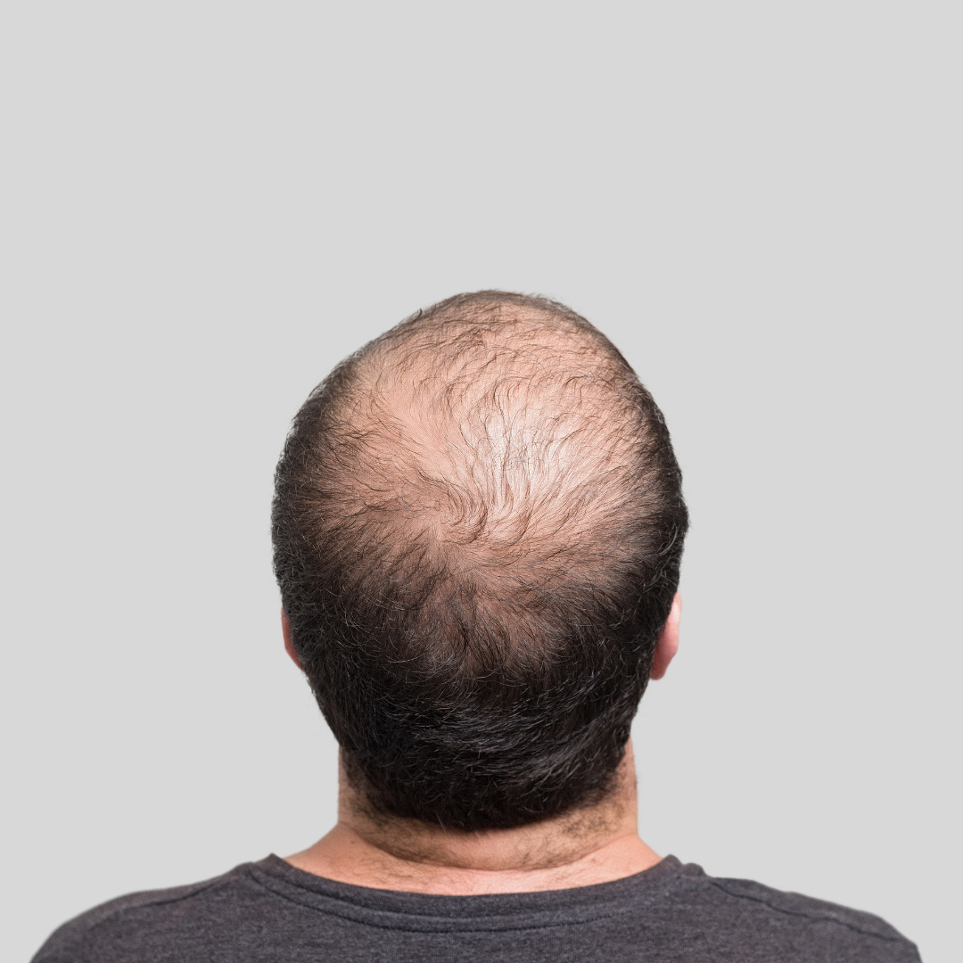 Baldness man in front of grey background