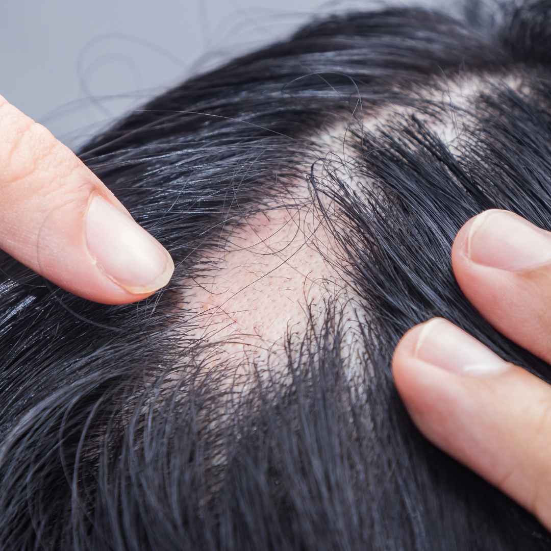 close up of a finger pointing at the spot baldness on scalp