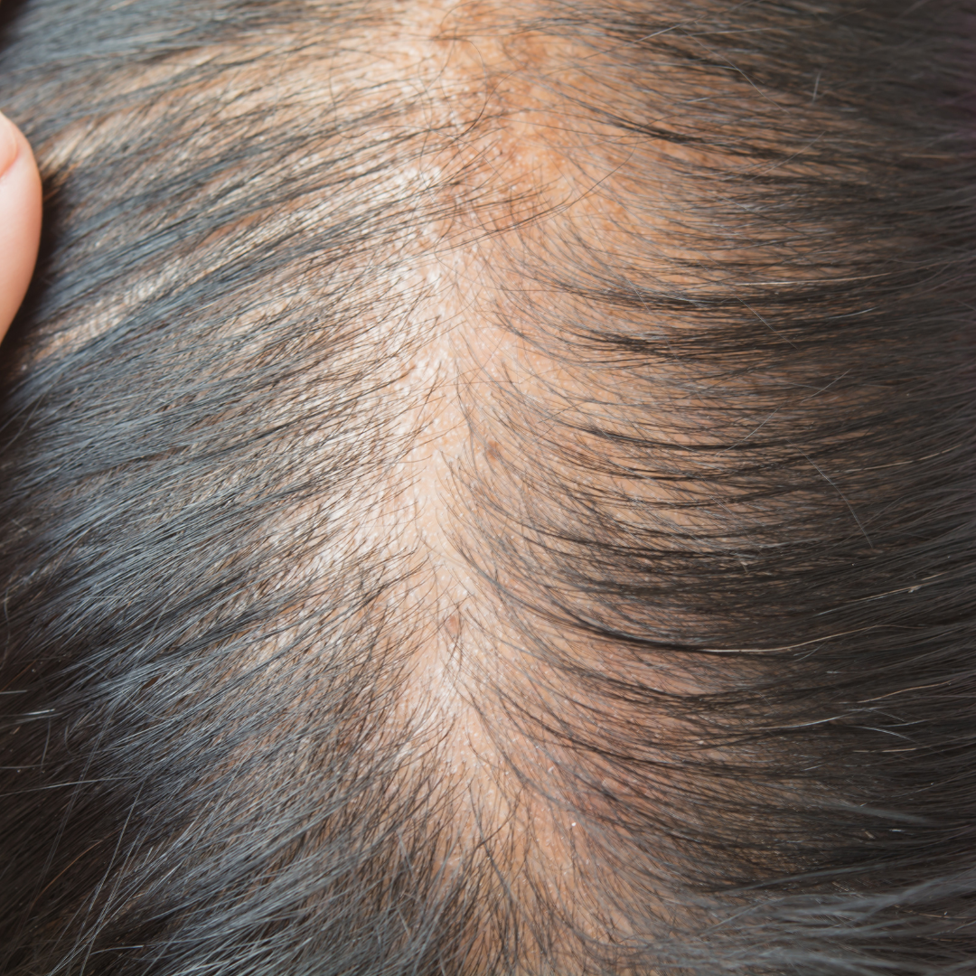 close up of thinning hair and scalp