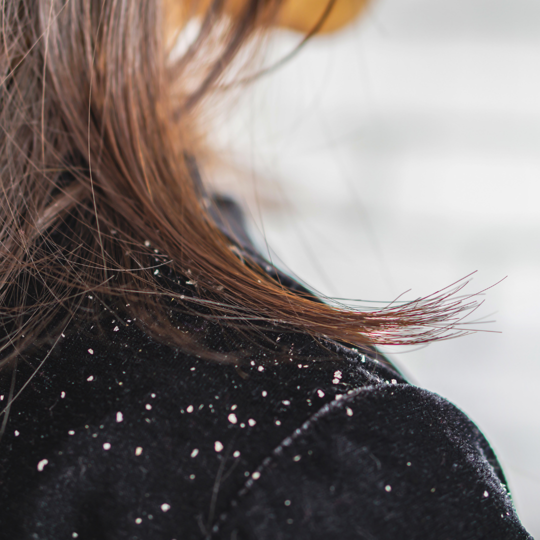 woman hair with dandruff falling on her shirt