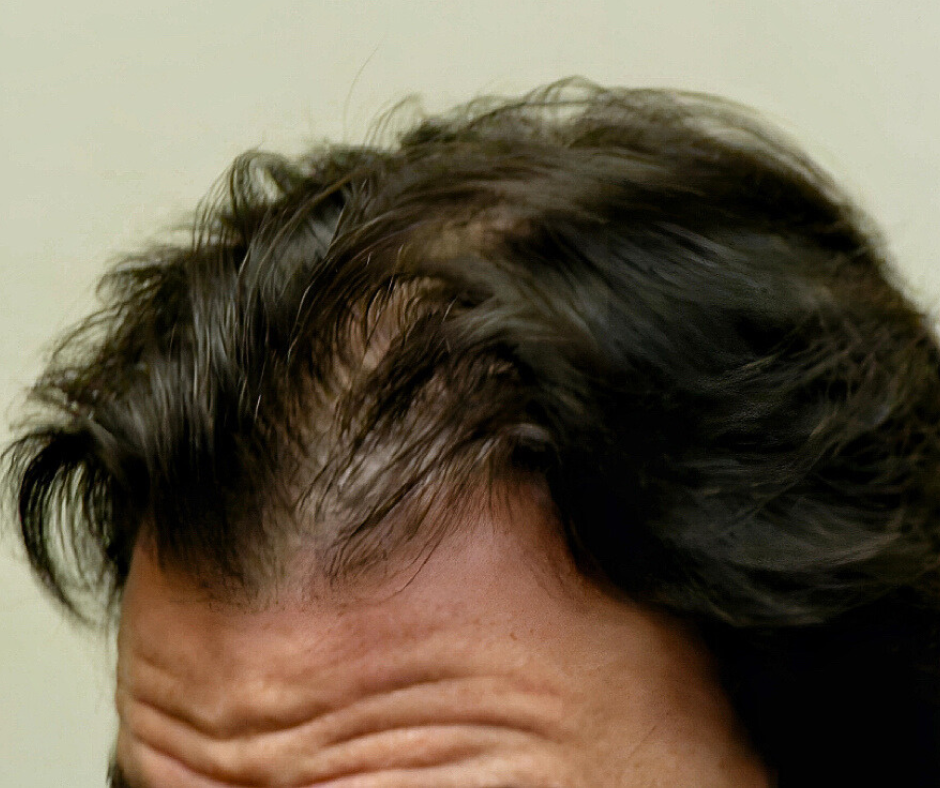 Close-up of a person's head with hair loss visible on a plain background