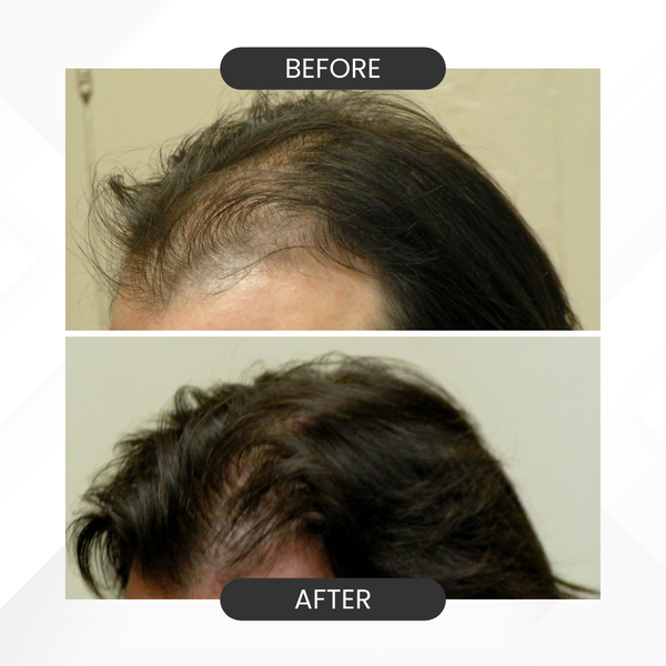 Before and after images of using bioscalp DHTI control kit