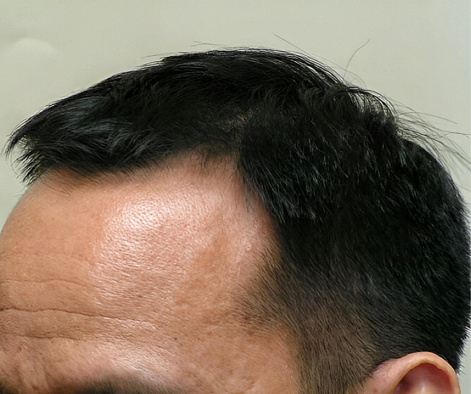Close-up of a person's head with dark hair and visible scalp.