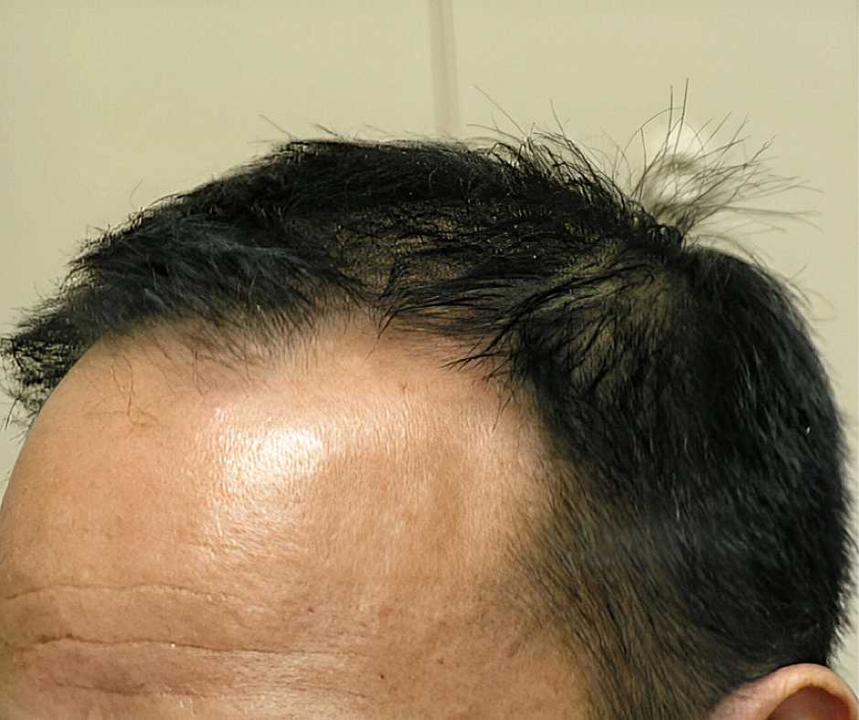 Close-up of a person's head with hairline and scalp visible