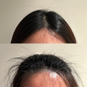 Before and after comparison of hairline and forehead on a plain background