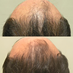 Top and bottom views of a person's scalp with hair density comparison.