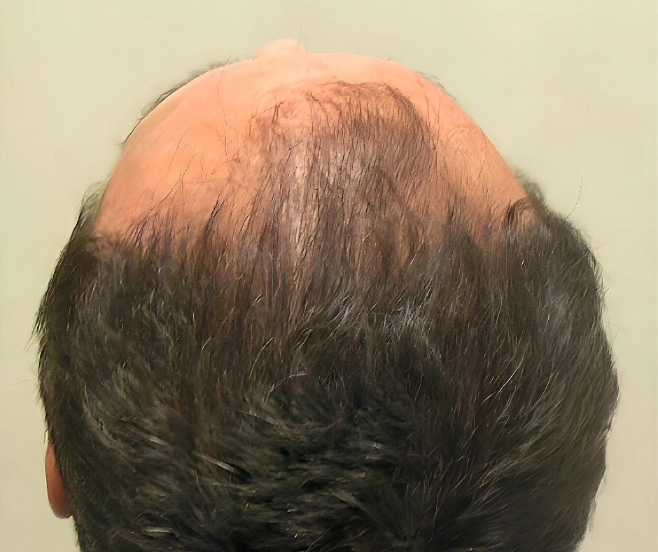 Back view of a person's head with thinning hair on a plain background
