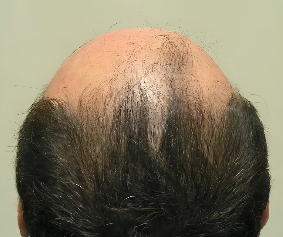 Back view of a person's head with hair loss on a plain background
