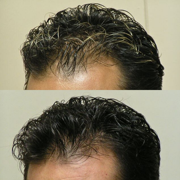 Two images showing a person's hairline before and after using BioScalp shampoo.