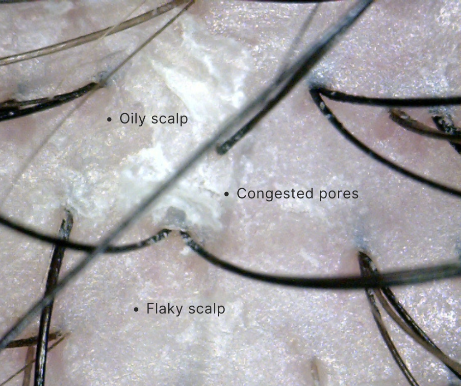 Close-up of scalp with text labels for oily scalp, congested pores, and flaky scalp.