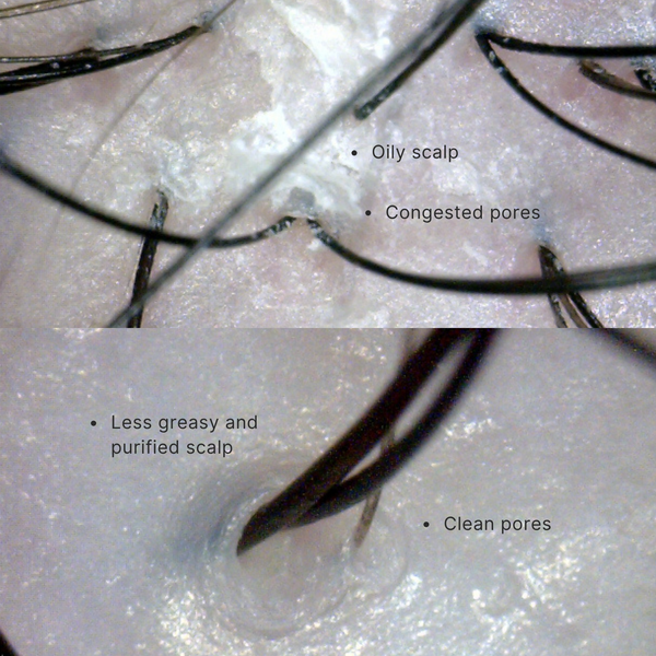 Comparison of an oily scalp with congested pores and a less greasy, purified scalp with clean pores.