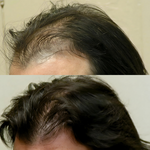 Before and after comparison of hair density on a person's head.