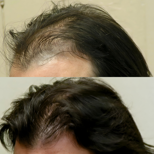 Before and after comparison of hair density on a person's head.