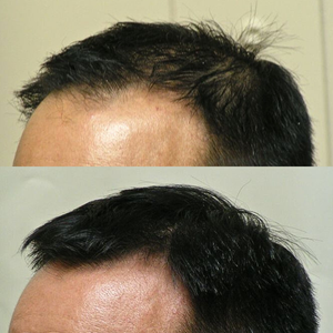 Before and after comparison of hair density on a person's head.