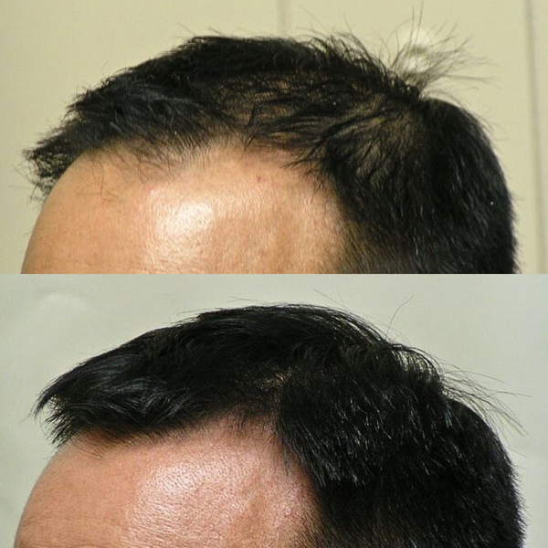 Before and after comparison of hair density on a person's head.