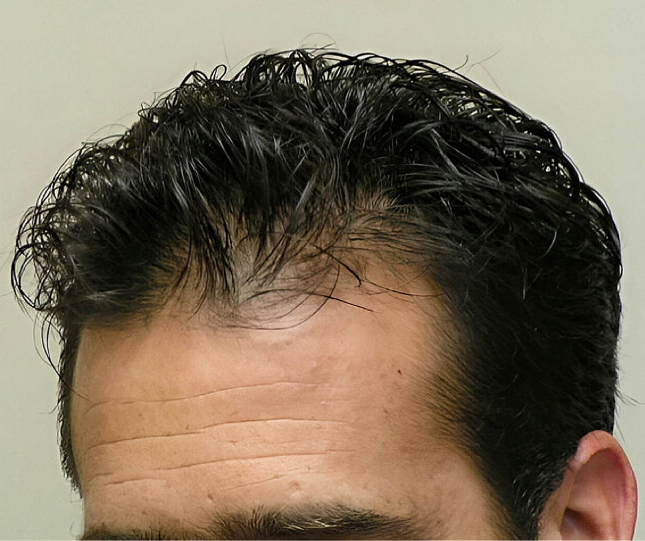 Close-up of a person's head with dark hair and visible scalp