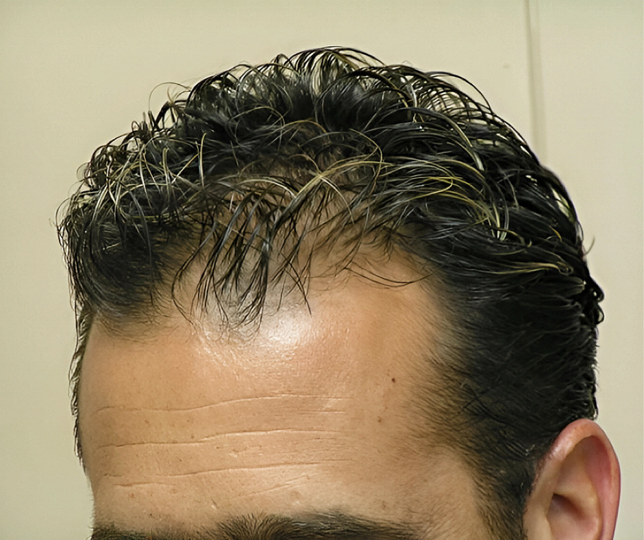 Close-up of a man's head with a focus on his hairline against a plain background