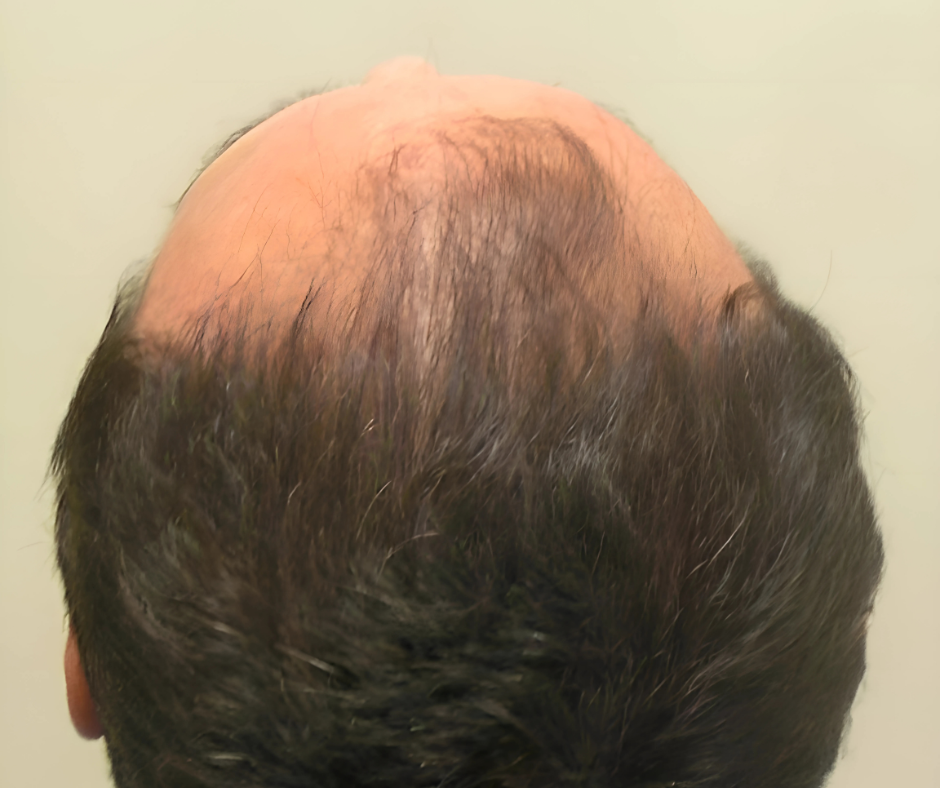 hairline returned with stronger hair