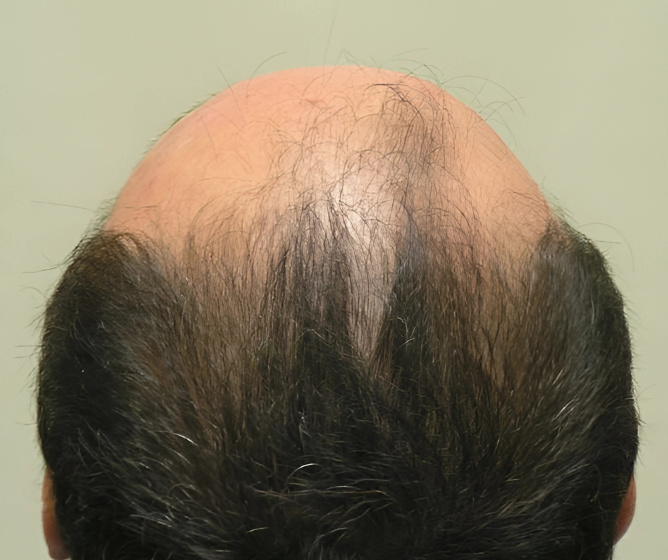 receding hairline and hair loss